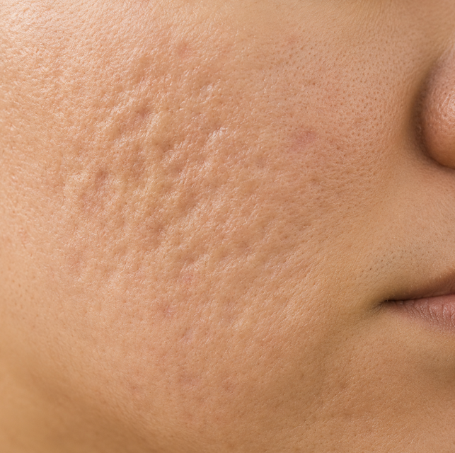 acne scar treatment