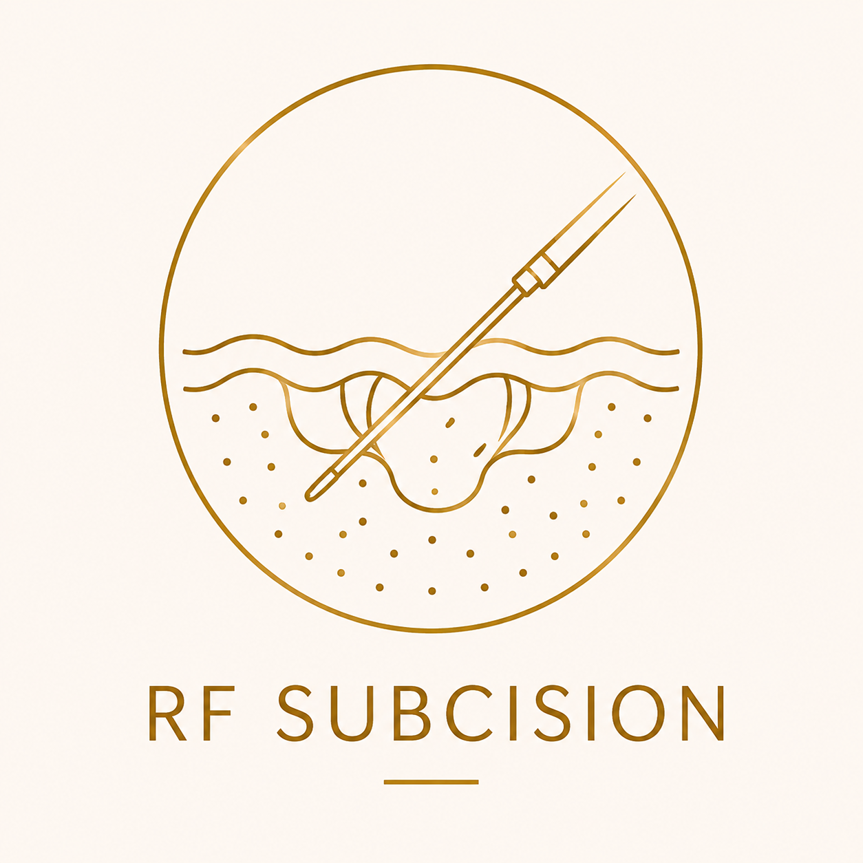 RF subcision treatment for tethered and rolling acne scars